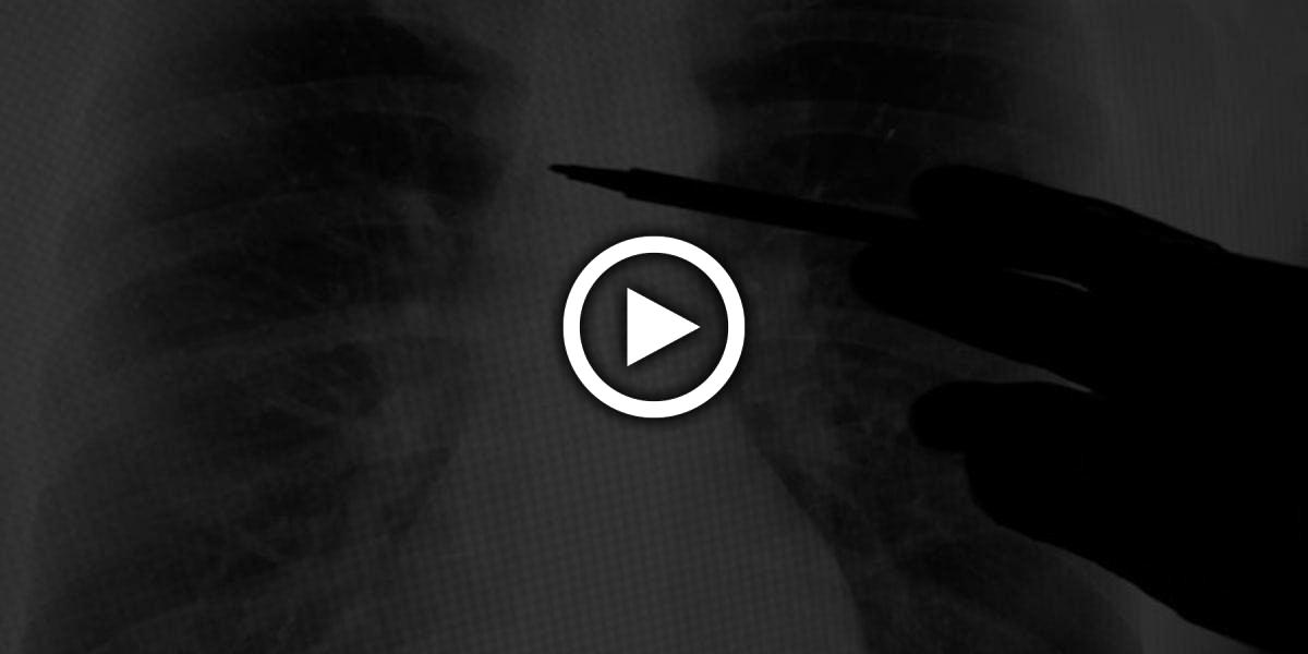 Forscher gelingt Durchbruch: So kann Long Covid im CT erkannt werden