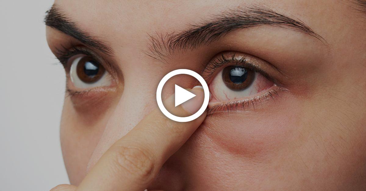 Augenkrankheiten erkennen: Diese Anzeichen darfst du nicht ignorieren